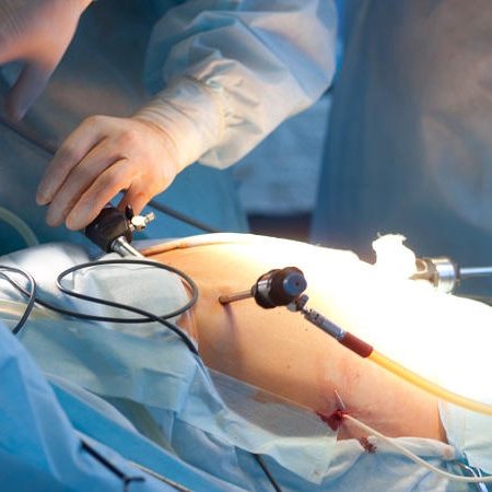 Gynecological-surgery